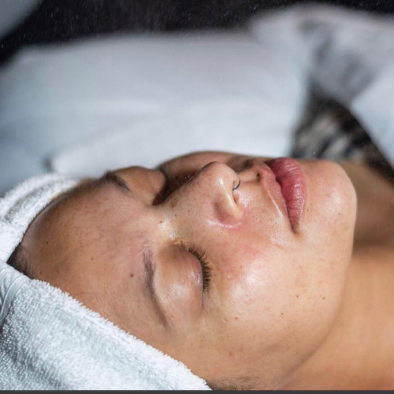 Facial microdermabrasion